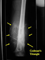 Limb-sparing surgery for osteosarcoma of distal femur - Plain x-rays