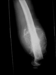 Limb-sparing surgery for osteosarcoma of distal femur - Plain x-rays