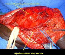 Intraoperative photos, Dissection