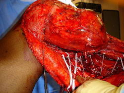 INTRAOPERATIVE IMAGES
