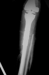 OSTOPERATIVE X-RAYS - proximal tibial prosthesis