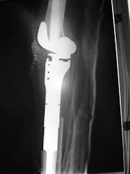 OSTOPERATIVE X-RAYS, Lateral x-ray,  proximal tibial prosthesis