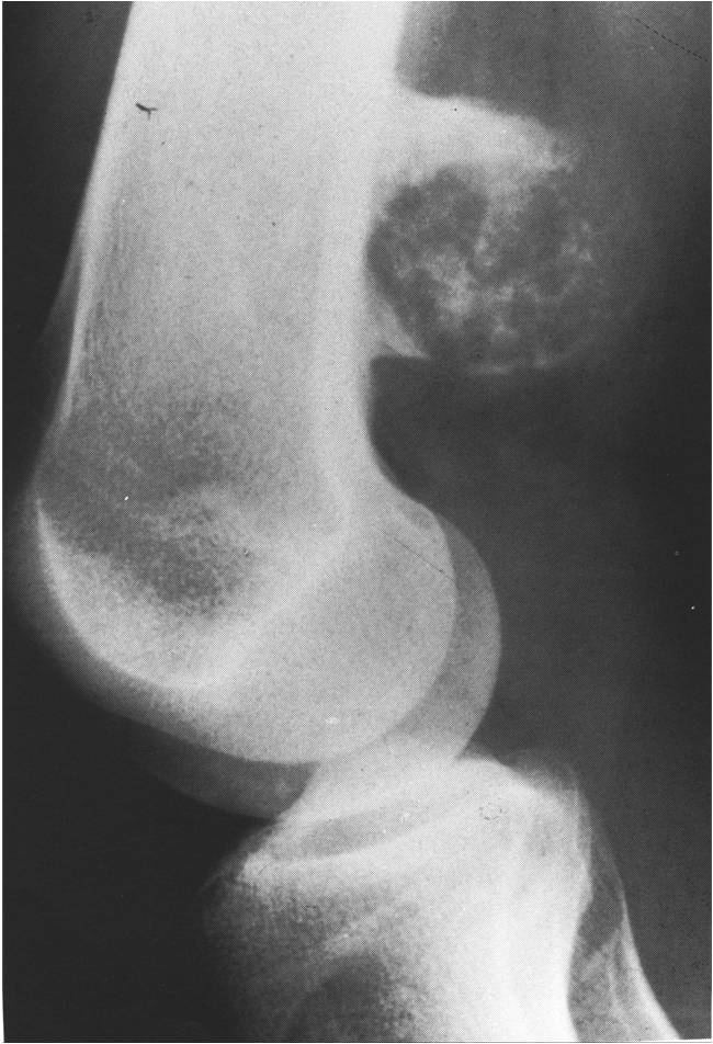 X-ray: Distal Femur Periosteal Chondroma