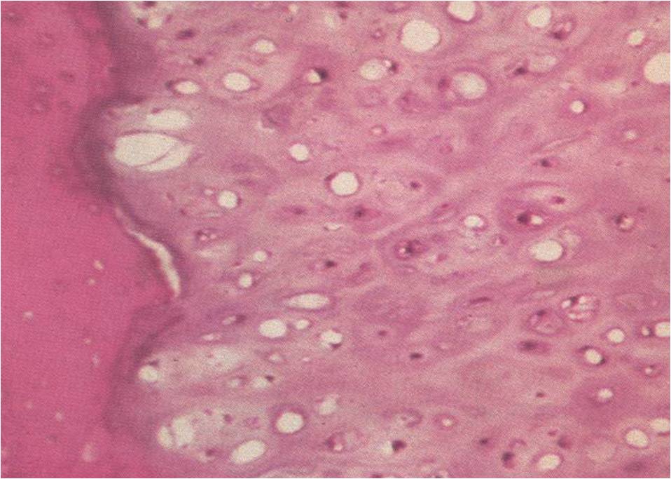 Microscopic Pathology: Periosteal Chondroma