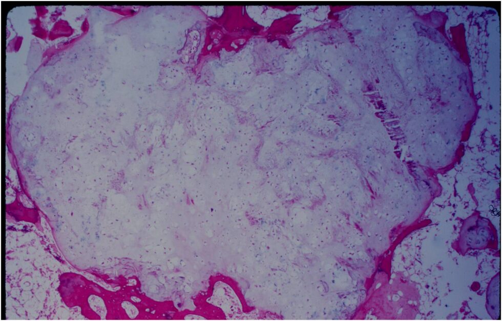 Enchondroma - Tumor Surgery Network