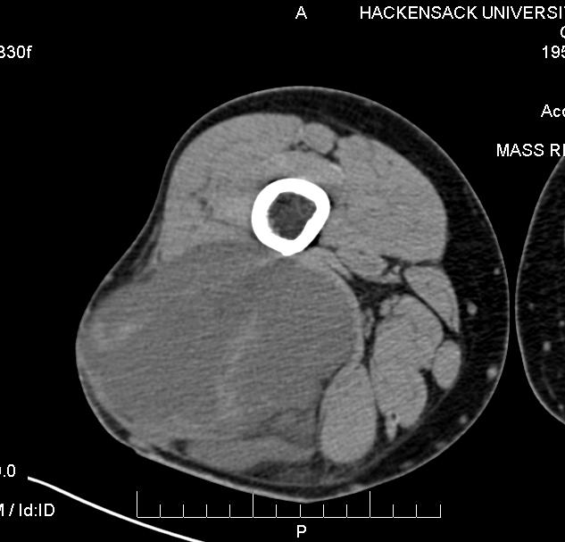 Fig. 1 CT scan image of a myxoid liposarcoma shows an inhomogeneous mass of low density that is located in the posterior compartment of the thigh.