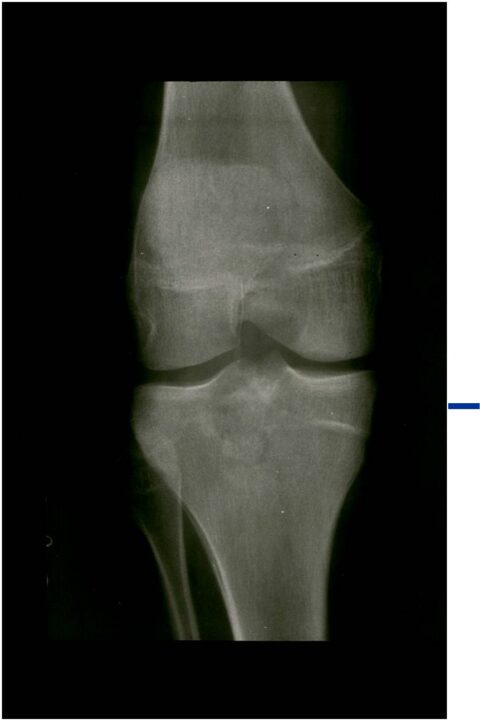 Chondroblastoma - Tumor Surgery Network