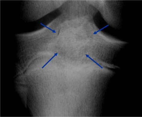 Chondroblastoma - Tumor Surgery Network