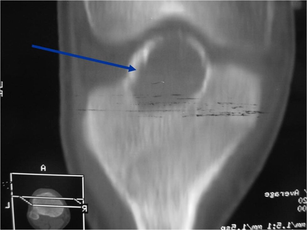 Chondroblastoma - Tumor Surgery Network