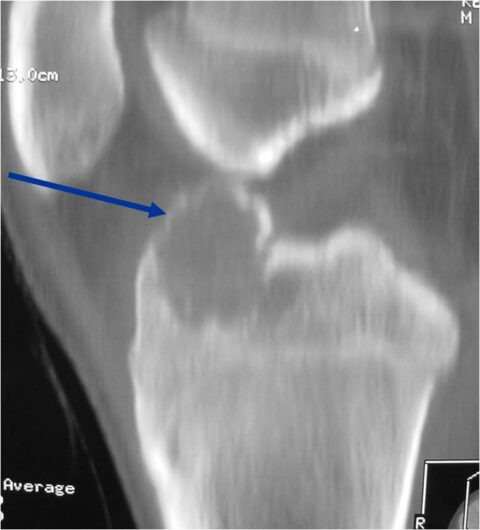 Chondroblastoma - Tumor Surgery Network
