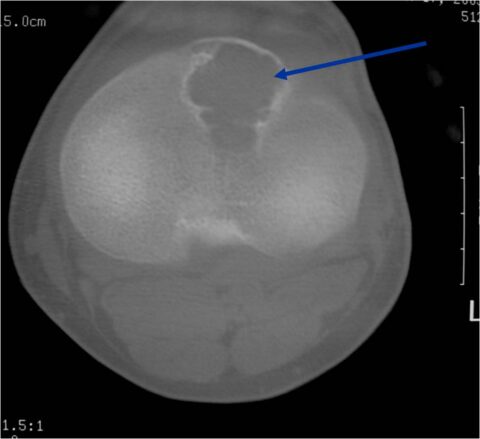 Chondroblastoma - Tumor Surgery Network
