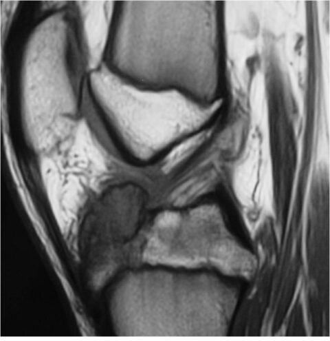 Chondroblastoma - Tumor Surgery Network