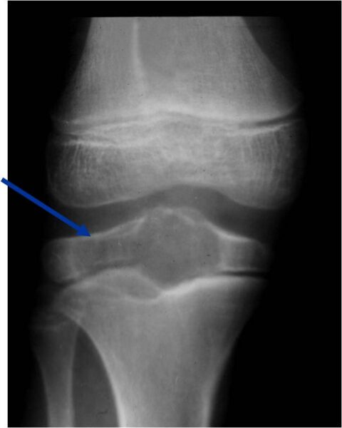Chondroblastoma - Tumor Surgery Network