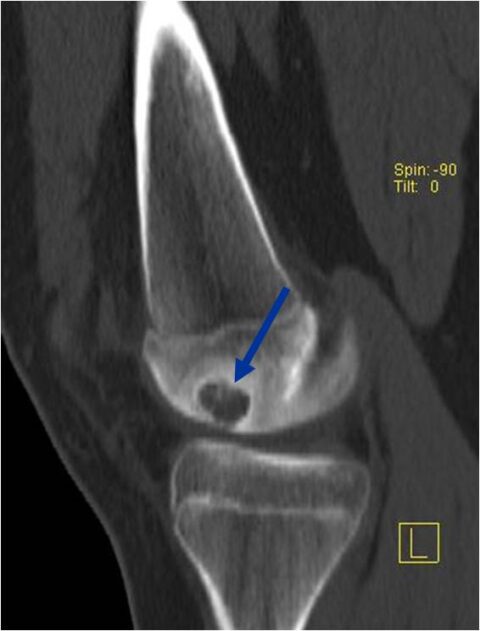 Chondroblastoma - Tumor Surgery Network