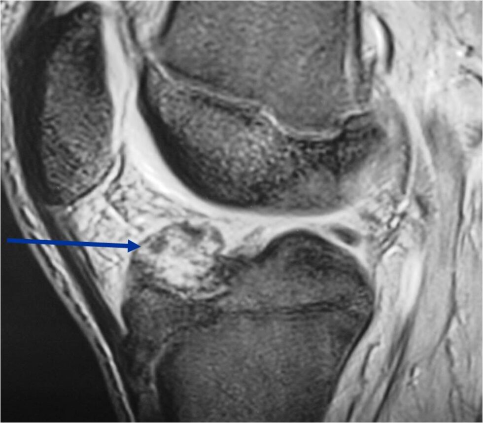 Chondroblastoma - Tumor Surgery Network