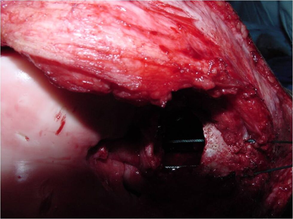 Chondroblastoma - Tumor Surgery Network