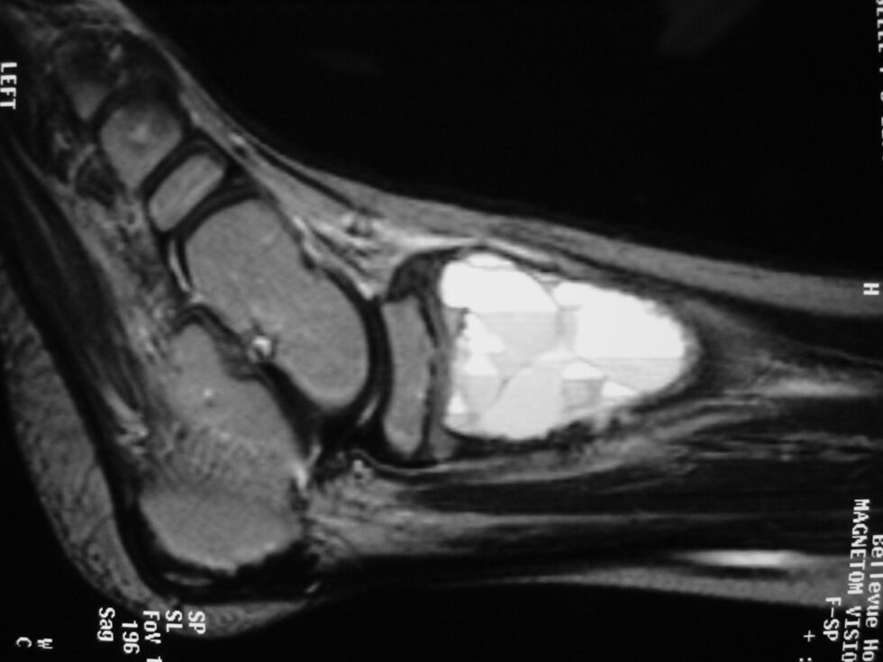 Aneurysmal Bone Cyst (ABC) - Tumor Surgery Network