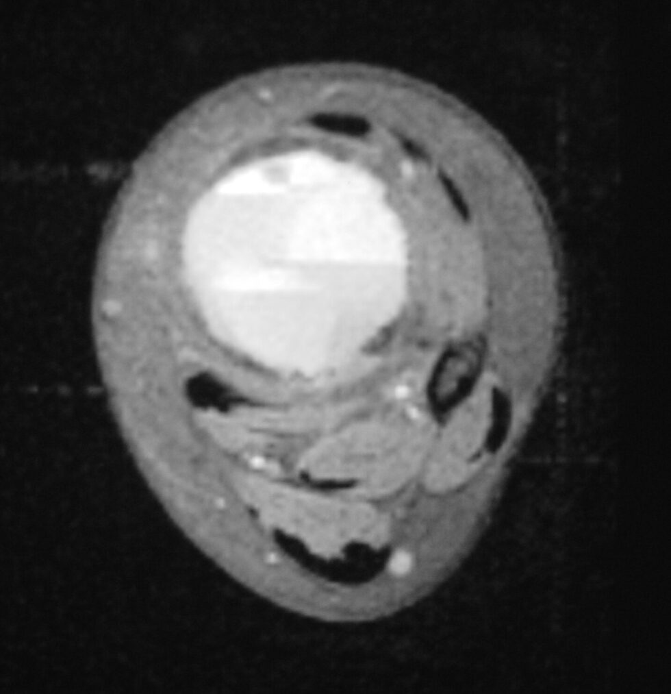 Aneurysmal Bone Cyst (ABC) - Tumor Surgery Network