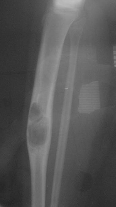 Adamantinoma: A Rare Bone Tumor of the Tibia Explained